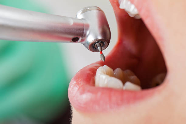 Best Emergency Root Canal Therapy in Grover, WY